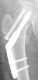 大腿骨頚部骨折（足の付け根の骨折）