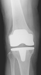 全人工膝関節置換術