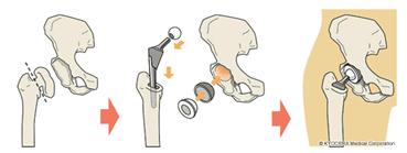 人工股関節置換術