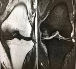 特発性膝関節骨壊死