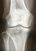 膝関節周囲脆弱性骨折