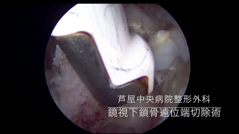 10鏡視下鎖骨遠位端切除術の写真