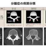 腰椎分離症の標準的治療と予後についてのサムネイル