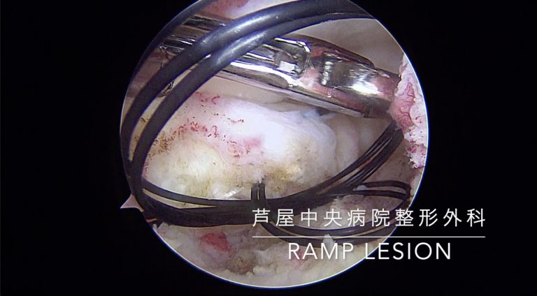 26. 膝の傾斜病変（ramp lesion）に対する手術
